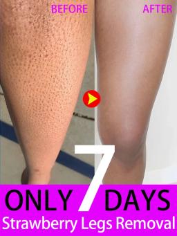 Keratosis Pilaris Removal Cream for Strawberry Legs Hydrating, moisturizing, deep cleansing rough body skin exfoliating scrub